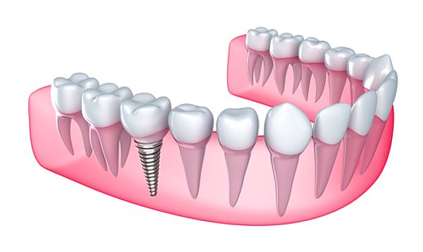 implant stomatologiczny