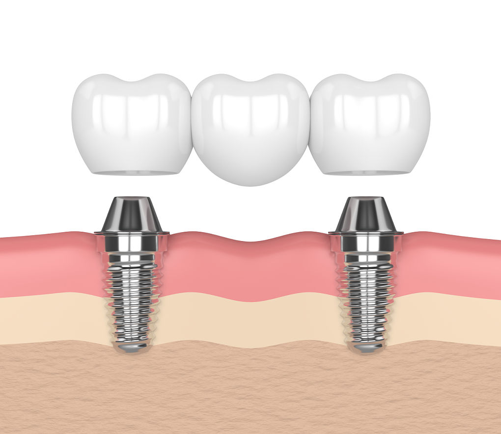 implant-zebowy-mostek